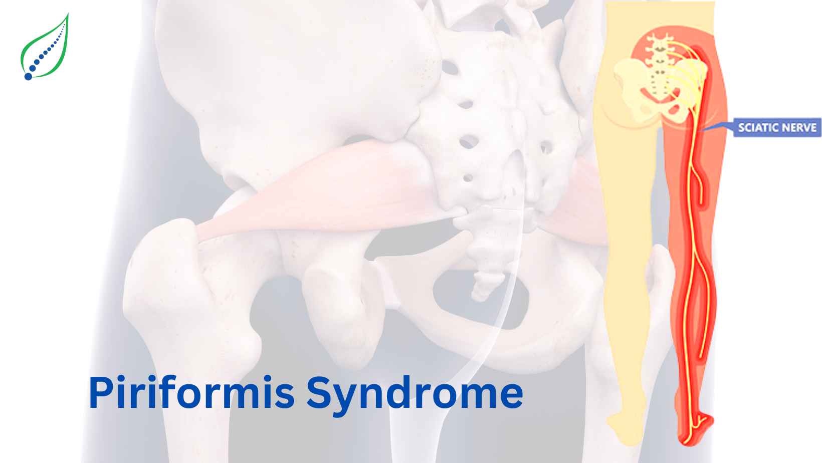 Piriformis Syndrome